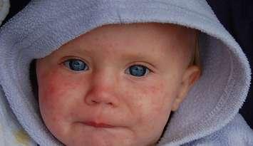 Child with measles by Dave Haygarth via Flickr