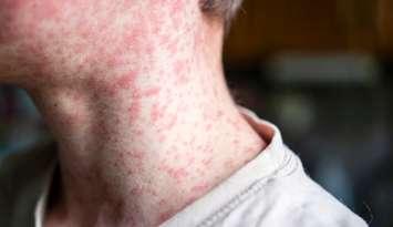 Measles rash. (Photo by Natalya Maisheva/iStock / Getty Images Plus)